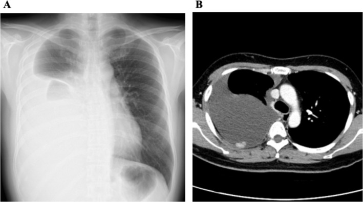 Radiotherapy-Induced Pleural Mesothelioma in a Childhood Leukaemia Survivor: A Case Report.