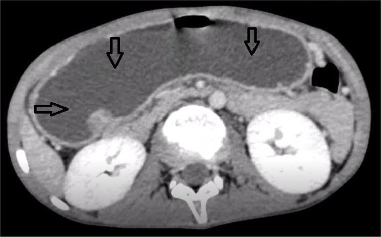 Annular Pancreas in a 13-Year-Old Boy: A Delayed Clinical Presentation of a Congenital Anomaly Highlighting Challenges of Diagnosis.