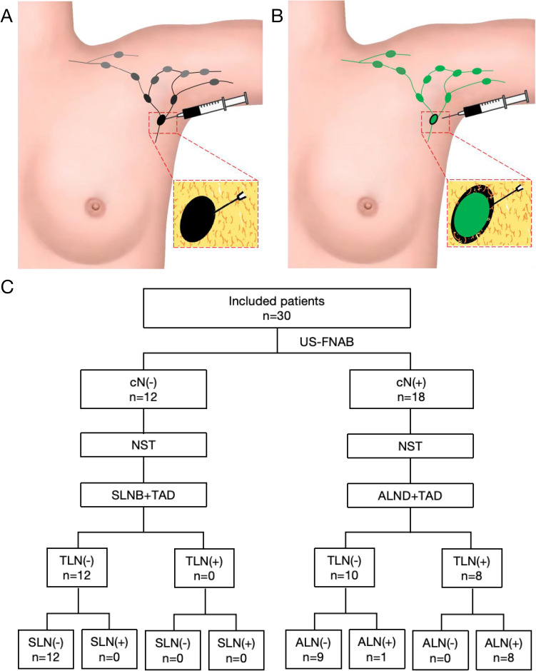 Peri-Lymph Node Tattooing with Carbon Nanoparticles Suspension: A Novel Strategy for Targeted Axillary Dissection in Breast Cancer.