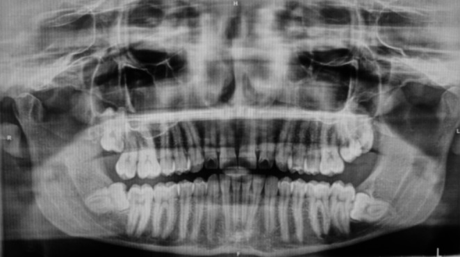 Using injectable Platelet-Rich fibrin to improve recovery after impacted lower third molar extraction: a randomized controlled clinical trial.