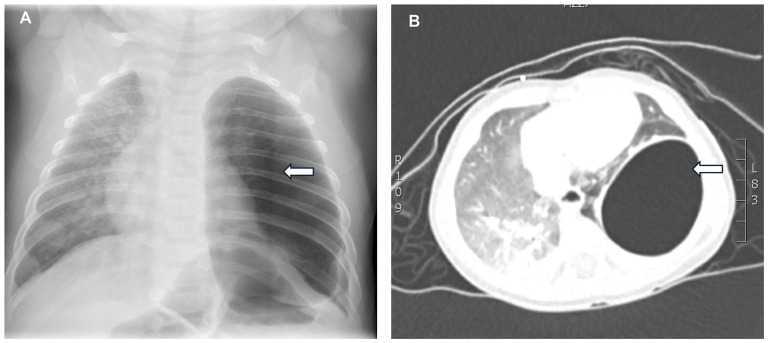 Pneumatoceles or Not? Case Reports on Pulmonary Cystic Lesions in Infants.