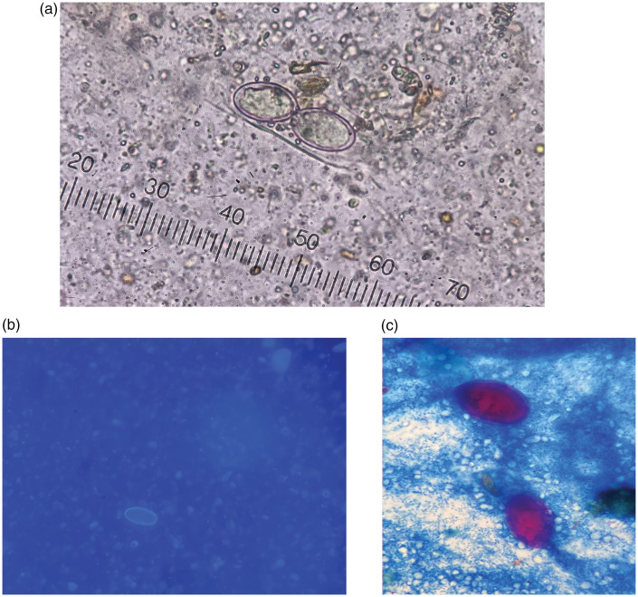 <i>Cryptosporidium</i> spp. infection occurring in patients with recurrent pancreatitis and primary Sjögren's syndrome: A case report.