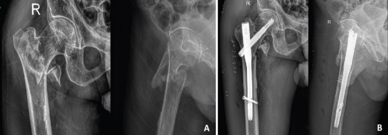 A Rare Case of Pseudoaneurysm of Profunda Femoris Artery Following Surgical Fixation of an Intertrochanteric Fracture.