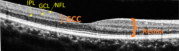 Evaluation of ganglion cell complex in patients taking hydroxychloroquine.