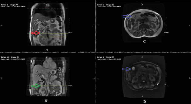 Defying the Prognostic Odds: A Case Report of Unexpected Complete Remission of Metastatic Ampullary Carcinoma With Palliative Chemotherapy.
