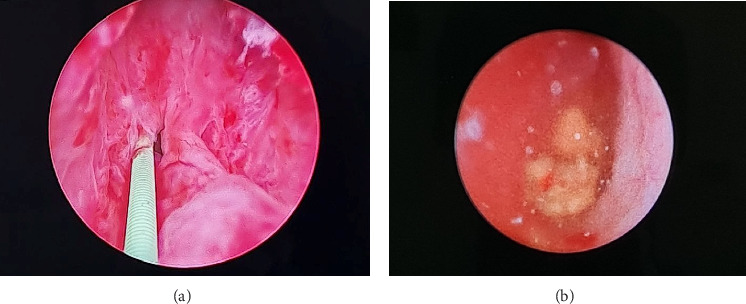 Complete Duplex Right Kidney With Upper Moiety Hydronephrosis due to Ureteral Stone: A Rare Case.