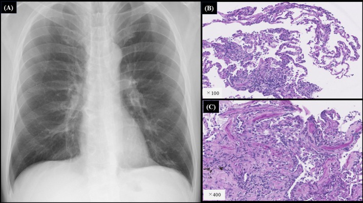 Asymptomatic Neurosyphilis Presenting With Bilateral Pulmonary Nodules: A Case Report.