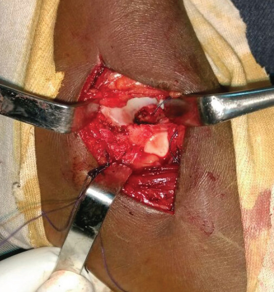 Aneurysmal Bone Cyst of Talus: A Case Report.