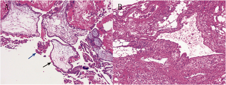 Retroperitoneal ectopic pregnancy localized to the mesorectum: A case report and mini-review of literature.