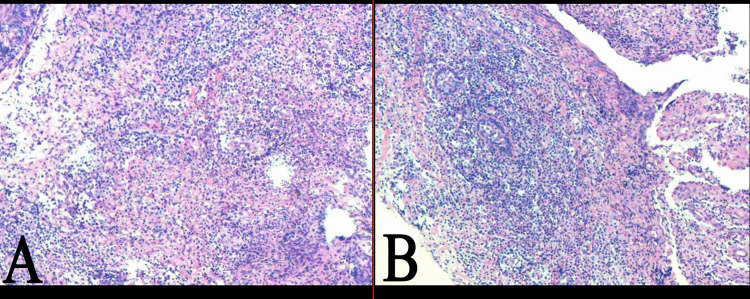 Surgical Management of Recurrent Plasma Cell Mastitis in a Male Patient: A Case Report.