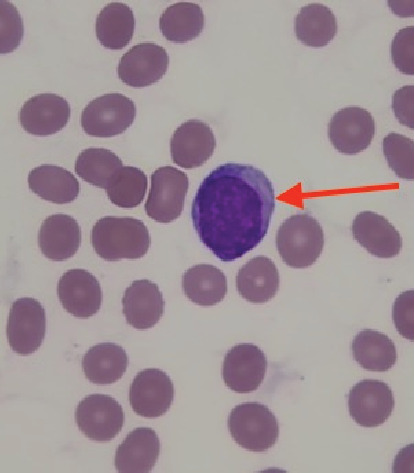 KIT-Negative Systemic Mastocytosis Associated With Acute Myeloid Leukemia.