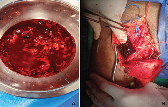 A Rare Case of Pseudoaneurysm of Profunda Femoris Artery Following Surgical Fixation of an Intertrochanteric Fracture.