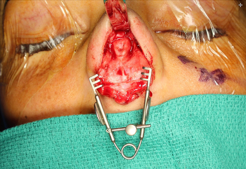 Use of Lacrimal Retractor in Rhinoplasty: A Boon for the Solo Rhinoplasty Surgeon.