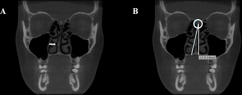 Is Concha Bullosa Associated with Nasal Septum Deviation and Mucosal Thickening of the Maxillary Sinuses? A Cone Beam Computed Tomography Study.