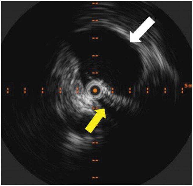 New daily persistent headache with May-Thurner physiology and spinal epidural venous congestion: treatment with ascending lumbar vein embolization.