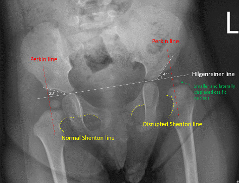 Physical Therapy Management for Delayed Diagnosis of Developmental Dysplasia of the Hip: A Case Report.