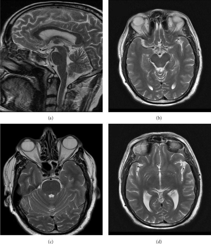 Othello Syndrome Induced by Dopamine Agonists in Parkinson's Disease: A Case Report.