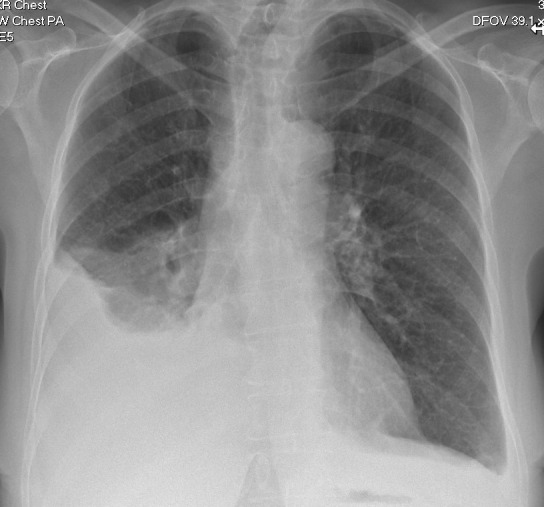 Bilateral pleural effusions, ascites and pulmonary emboli: Meigs syndrome.