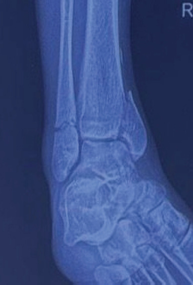 Triple-Segmental Shaft Femur Fracture: A Case Report.