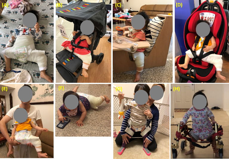 Physical Therapy Management for Delayed Diagnosis of Developmental Dysplasia of the Hip: A Case Report.