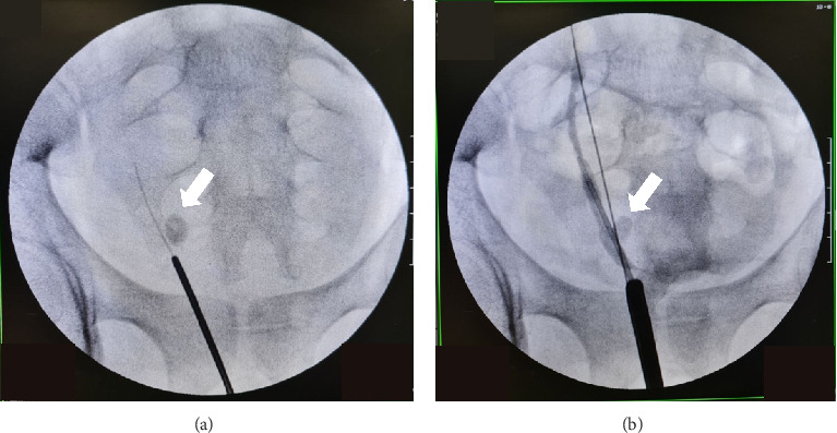 Complete Duplex Right Kidney With Upper Moiety Hydronephrosis due to Ureteral Stone: A Rare Case.