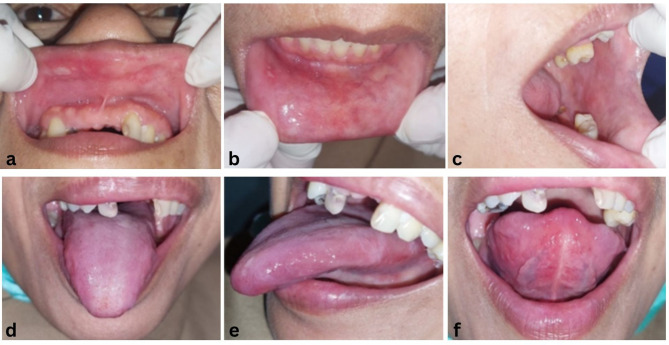 Salted Fish and Their Impact on Oral Health: A Risk for Lichen Planus.