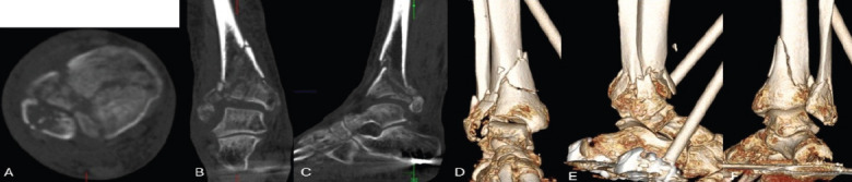 Tibiotalar Nailing for Geriatric Pilon Fractures: Case Report and Review of the Literature.