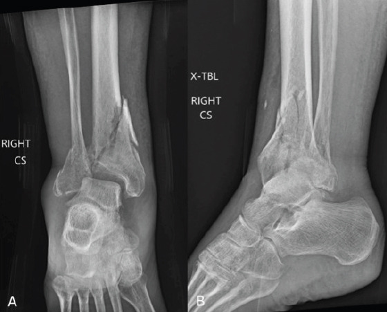 Tibiotalar Nailing for Geriatric Pilon Fractures: Case Report and Review of the Literature.
