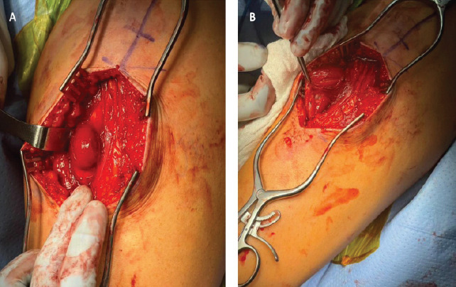 Operative Management of a Chronic Proximal Rectus Femoris Muscle Tear in a Collegiate Athlete: A Case Report.
