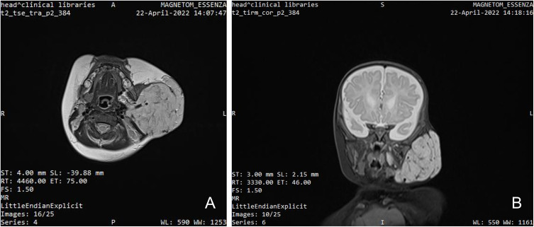 Metronomic Chemotherapy in the Treatment of Infantile Parotid Hemangioma - A Case Report.