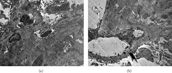 Acquired Renal Amyloidosis in a Patient With X-Linked Hyper-IgM Immunodeficiency With Novel Hemizygotic Pathogenic Variant in CD40LG Gene.