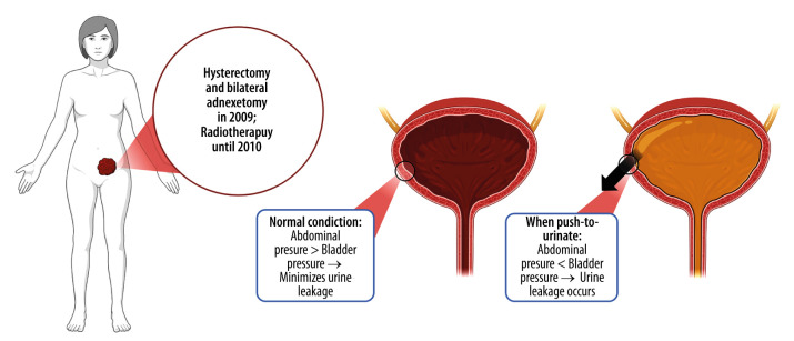 Radiotherapy-Related Bladder Fistula: A Hidden Cause of Recurrent Abdominal Symptoms.