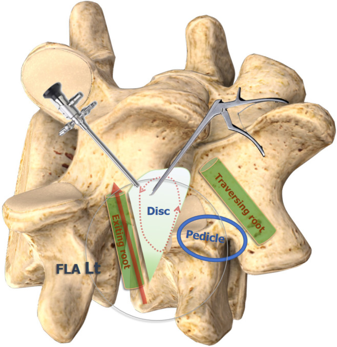 Unilateral biportal endoscopy for minimally invasive spinal fusion: Advancements in biomaterials and clinical outcome optimization.