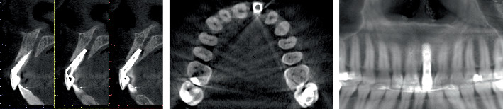 Interdisciplinary Management of Biological and Prosthetic Implant Complications in the Esthetic Zone: A Case Report.