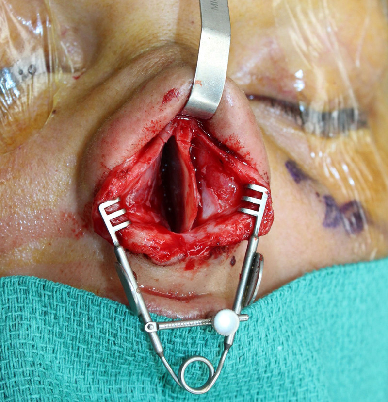 Use of Lacrimal Retractor in Rhinoplasty: A Boon for the Solo Rhinoplasty Surgeon.