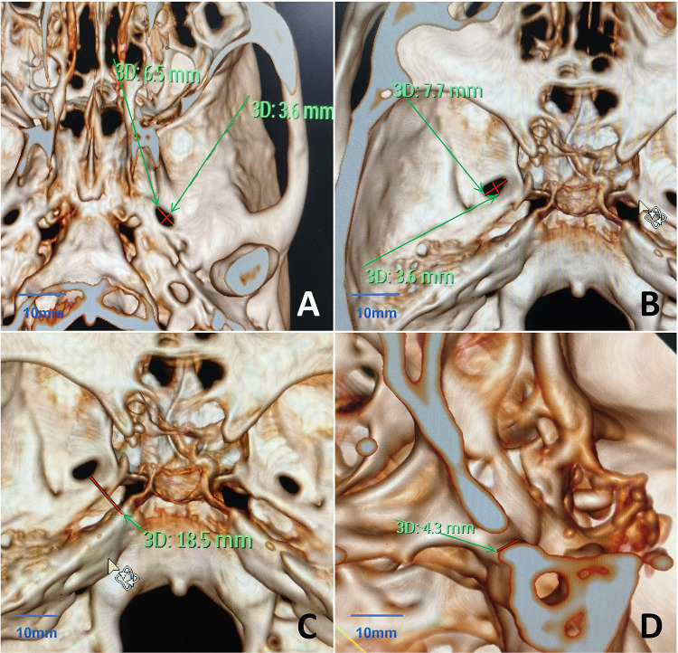 Application of Intraoperative Awake Anesthesia and Three-Dimensional Reconstruction Technique in Percutaneous Microballoon Compression for Trigeminal Neuralgia.