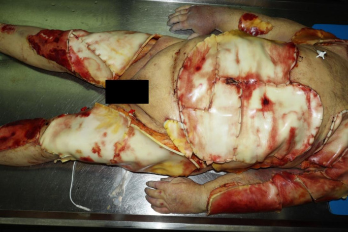 Lack of gastric emptying at autopsy eleven days after heat trauma in the sauna- a forensic autopsy case report.