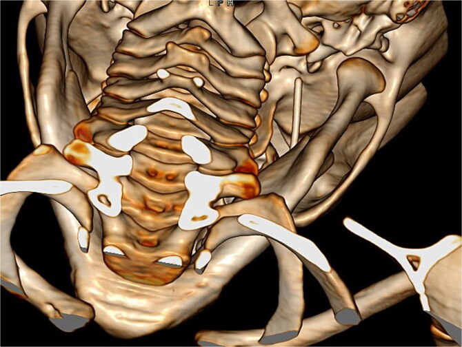 Multidisciplinary management of intracranial migration of a fractured dental needle through the foramen ovale: a case report.