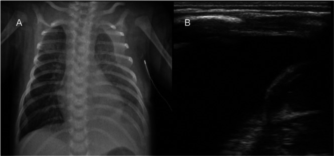 Persistent Low-Output Neonatal Chylothorax: How Long Are We Justified to Wait for Pleurodesis in Partial Responders?
