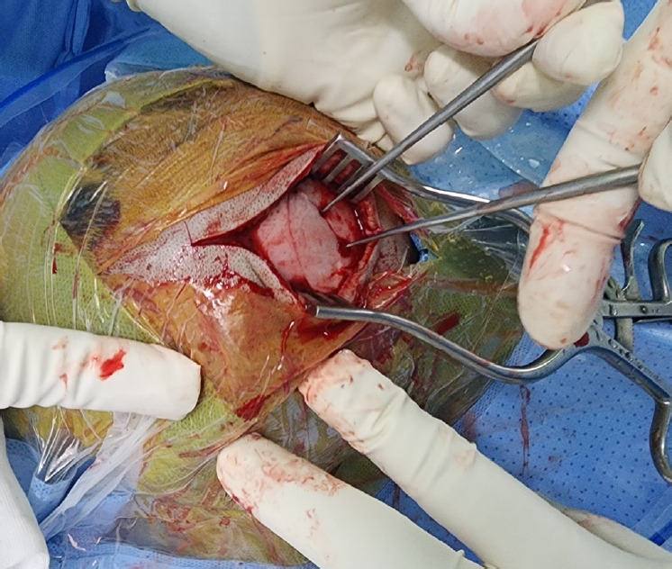 Successful minimally invasive reduction surgery with a micro burr hole in a pediatric patient with depressed skull fracture: a case report.