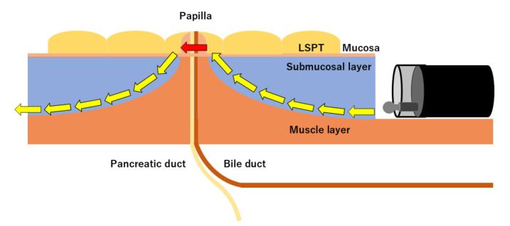 Efficacy and safety of endoscopic submucosal dissection versus endoscopic papillectomy for managing laterally spreading duodenal papillary tumors.