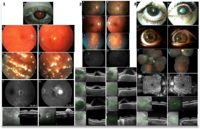 Clinical characteristics and long-term outcomes of Vogt-Koyanagi-Harada disease in pediatric age group.