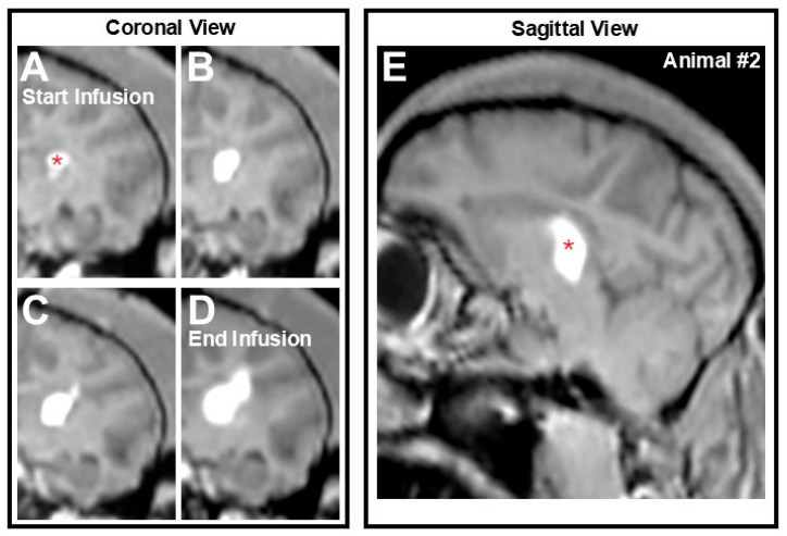 A Preliminary Study on the Accuracy of MRI-Guided Thalamic Infusion of AAV2-GFP and Biodistribution Analysis Using Cryo-Fluorescence Tomography in Nonhuman Primates.