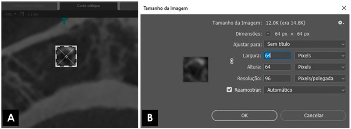 Influence of cone-beam computed tomography reconstruction parameters on bone fractal dimension: A cross-sectional observational study.