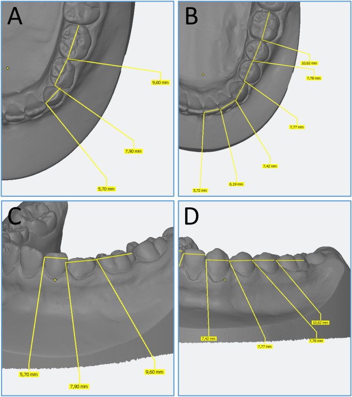 Mesiodistal width correlation between primary and successor mandibular teeth: implication for early orthodontic diagnosis.