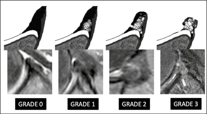 SHORT-TERM MRI EVALUATION OF CAPSULOLABRAL REPAIR IN ATHLETES WITH ANTERIOR GLENOHUMERAL INSTABILITY: CORRELATION WITH CLINICAL OUTCOMES.