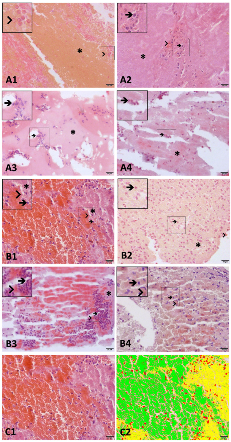 Optical and Scanning Electron Microscopy Thrombus Findings in Patients with STEMI Undergoing Primary Versus Rescue PCI.
