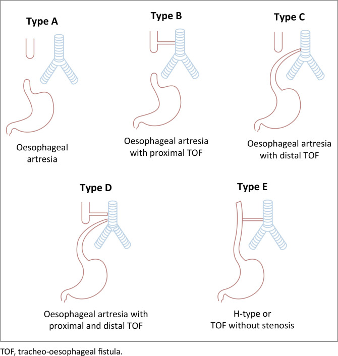 Unveiling tracheo-oesophageal fistula: The crucial role of imaging in the diagnosis and management.