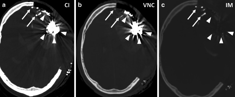 In Vivo Discrimination of Iodine and Tantalum-Based Liquid Embolics After Intracranial or Spinal Embolization Using Photon-Counting Detector CT.
