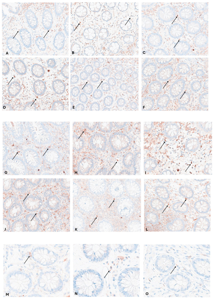Interferon Regulator Factor 5: A Novel Inflammatory Marker and Promising Therapeutic Target in Ulcerative Colitis.